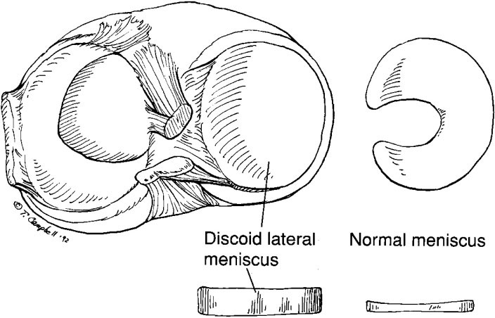 Discoid Meniscus - Children's Bone And Spine Surgery